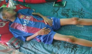 Kisah Pilu Malik; Anak Yatim Piatu di Bangkalan Terbaring Lemas Akibat Gizi Buruk