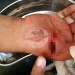 Jadi Korban Penganiayaan, Warga Legung Timur Alami Luka Robek