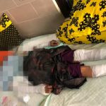 Tabung Gas Bocor, Nenek di Kalianget Mengalami Luka Bakar