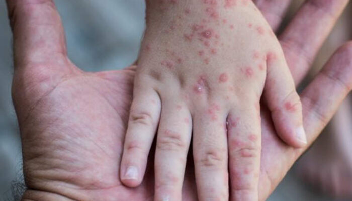 Wabah Campak Meledak di Sumenep, Kadinkes: Semua Tak Diimunisasi